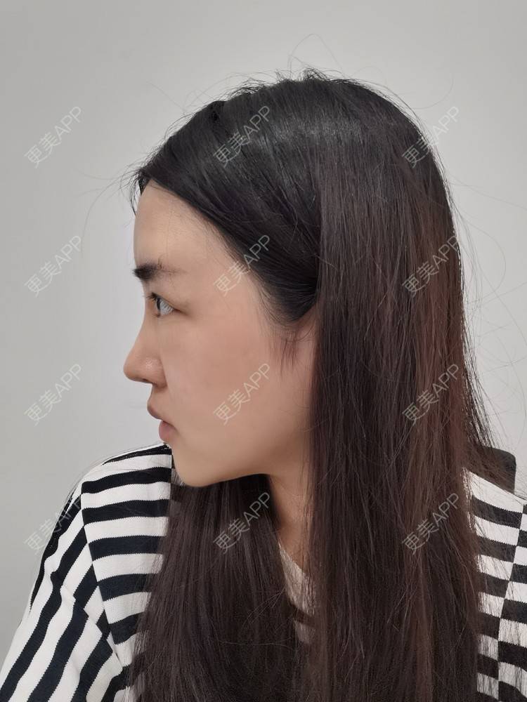 更美 - 更美用户UwcX1dQHsO的垫眉弓经验 | 膨体垫眉弓 | 垫眉弓 | 硅胶垫眉弓 | 自体脂肪垫眉弓 | 玻尿酸眉弓