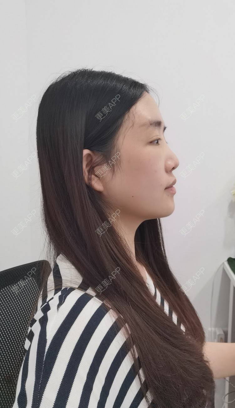 更美 - 更美用户UwcX1dQHsO的垫眉弓经验 | 膨体垫眉弓 | 垫眉弓 | 硅胶垫眉弓 | 自体脂肪垫眉弓 | 玻尿酸眉弓