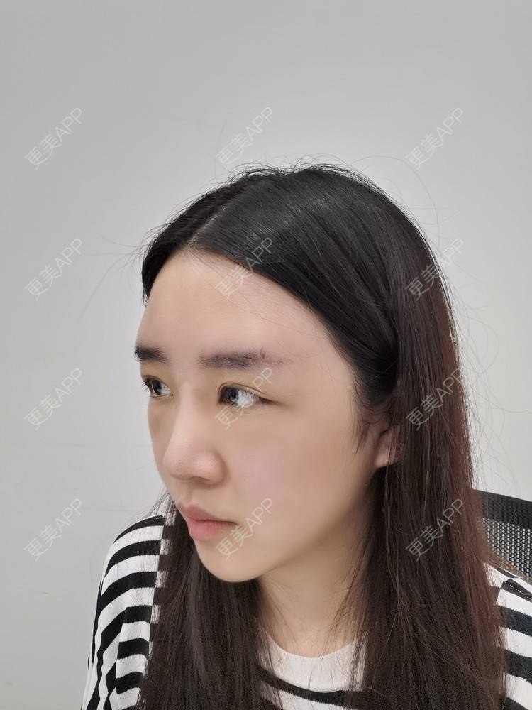 更美 - 更美用户UwcX1dQHsO的垫眉弓经验 | 膨体垫眉弓 | 垫眉弓 | 硅胶垫眉弓 | 自体脂肪垫眉弓 | 玻尿酸眉弓