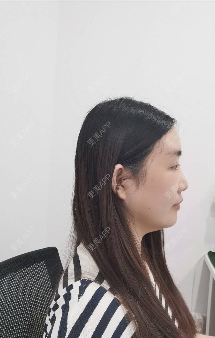 更美 - 更美用户UwcX1dQHsO的垫眉弓经验 | 膨体垫眉弓 | 垫眉弓 | 硅胶垫眉弓 | 自体脂肪垫眉弓 | 玻尿酸眉弓