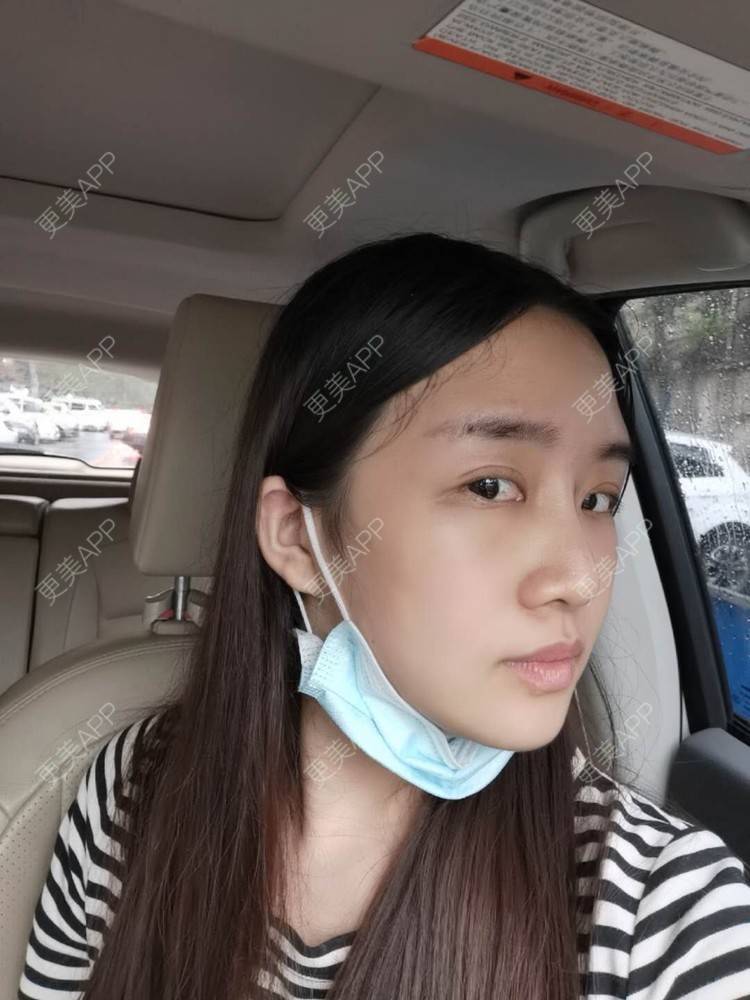 更美 - 更美用户UwcX1dQHsO的垫眉弓经验 | 膨体垫眉弓 | 垫眉弓 | 硅胶垫眉弓 | 自体脂肪垫眉弓 | 玻尿酸眉弓
