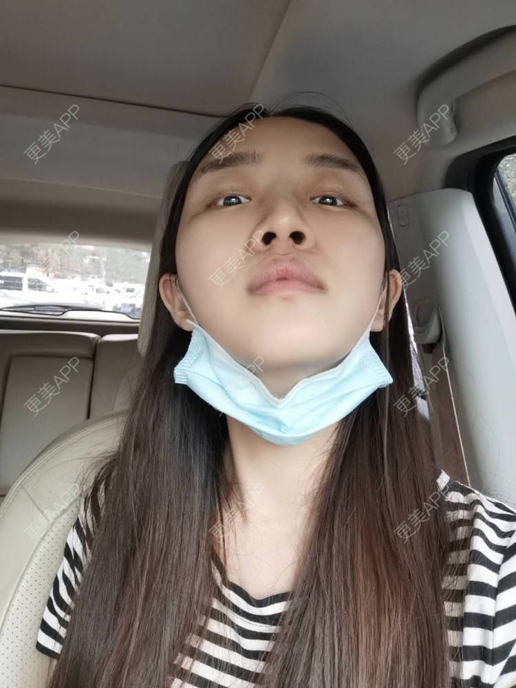 更美 - 更美用户UwcX1dQHsO的垫眉弓经验 | 膨体垫眉弓 | 垫眉弓 | 硅胶垫眉弓 | 自体脂肪垫眉弓 | 玻尿酸眉弓