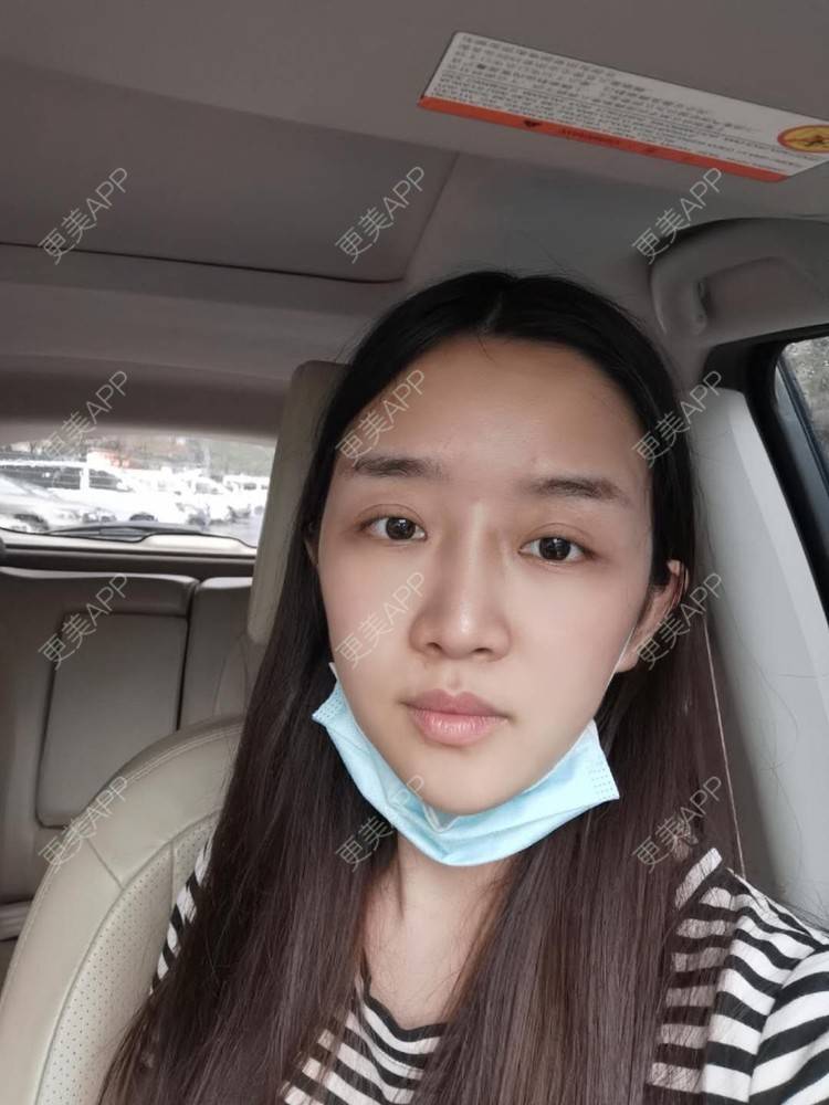 更美 - 更美用户UwcX1dQHsO的垫眉弓经验 | 膨体垫眉弓 | 垫眉弓 | 硅胶垫眉弓 | 自体脂肪垫眉弓 | 玻尿酸眉弓