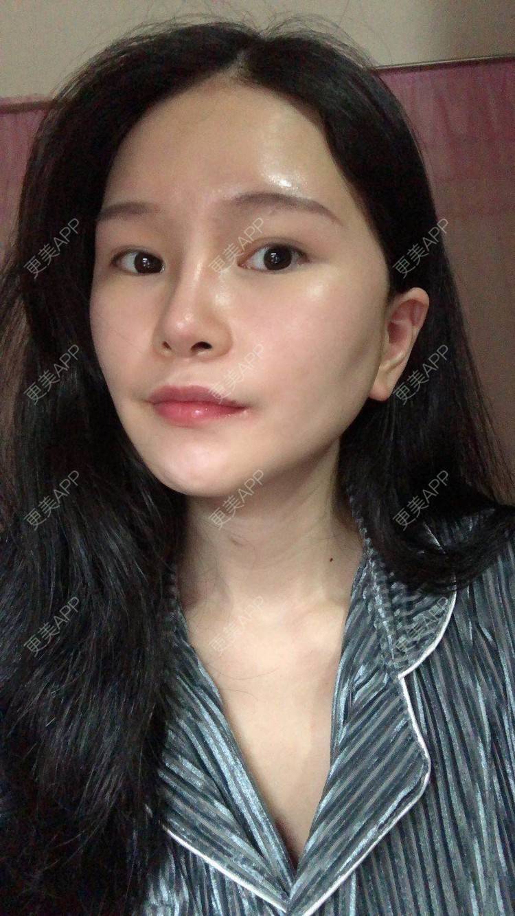 更美 - 更美用户1hOuWDVG0V的下颌角经验 | 成都 | 下颌角