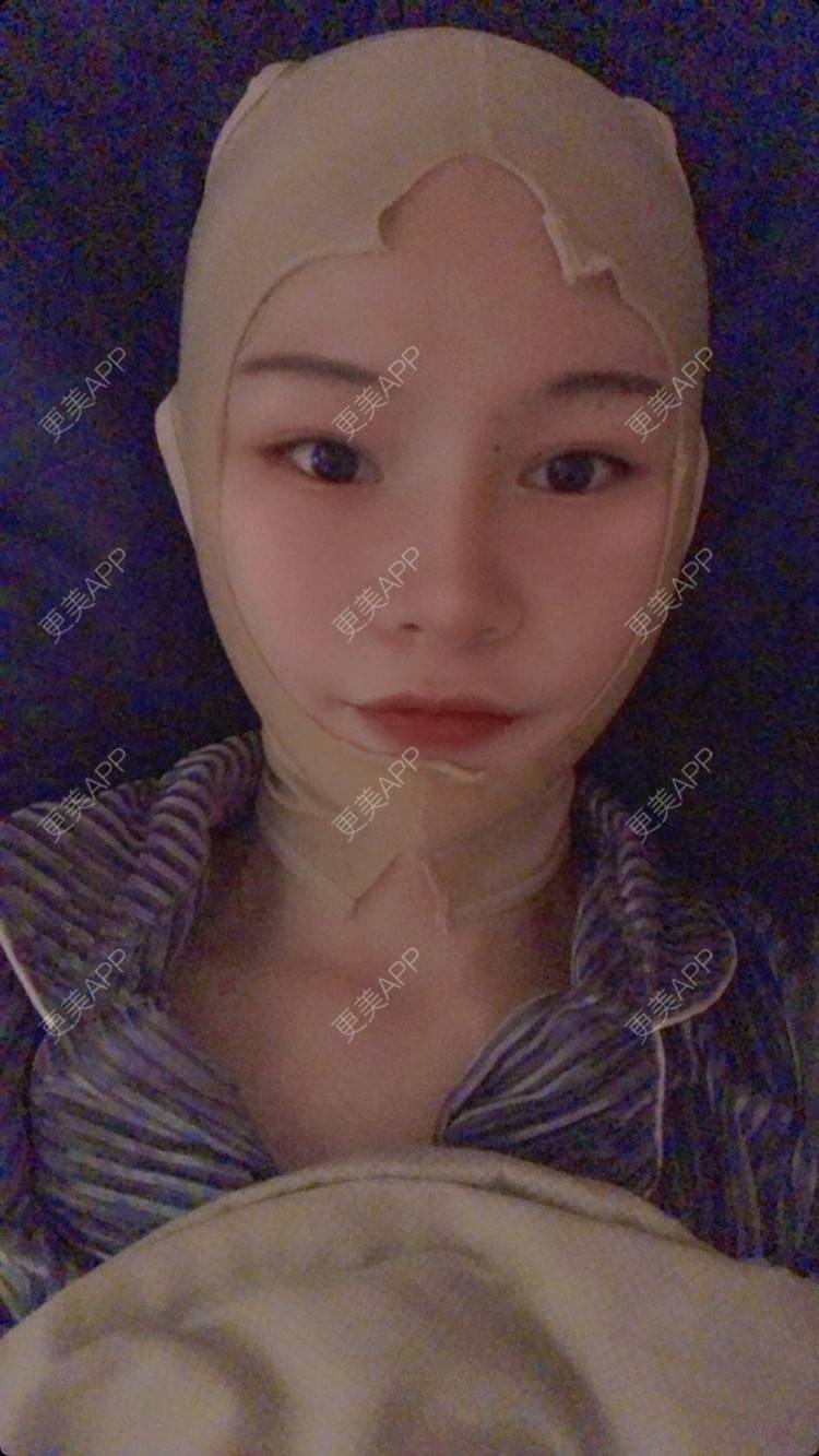 更美 - 更美用户1hOuWDVG0V的下颌角经验 | 成都 | 下颌角
