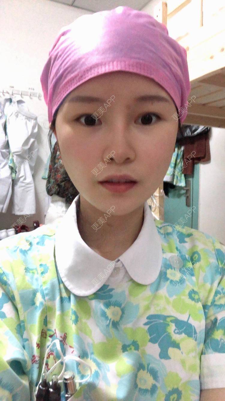 更美 - 更美用户1hOuWDVG0V的下颌角经验 | 成都 | 下颌角