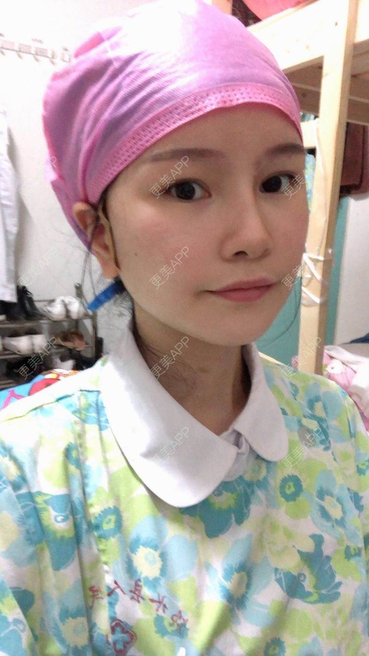 更美 - 更美用户1hOuWDVG0V的下颌角经验 | 成都 | 下颌角