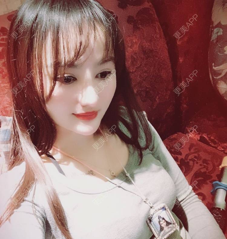 更美 - 更美用户tYzlahBO6T的植发际线经验 | 植发际线 | 深圳 | 毛发移植