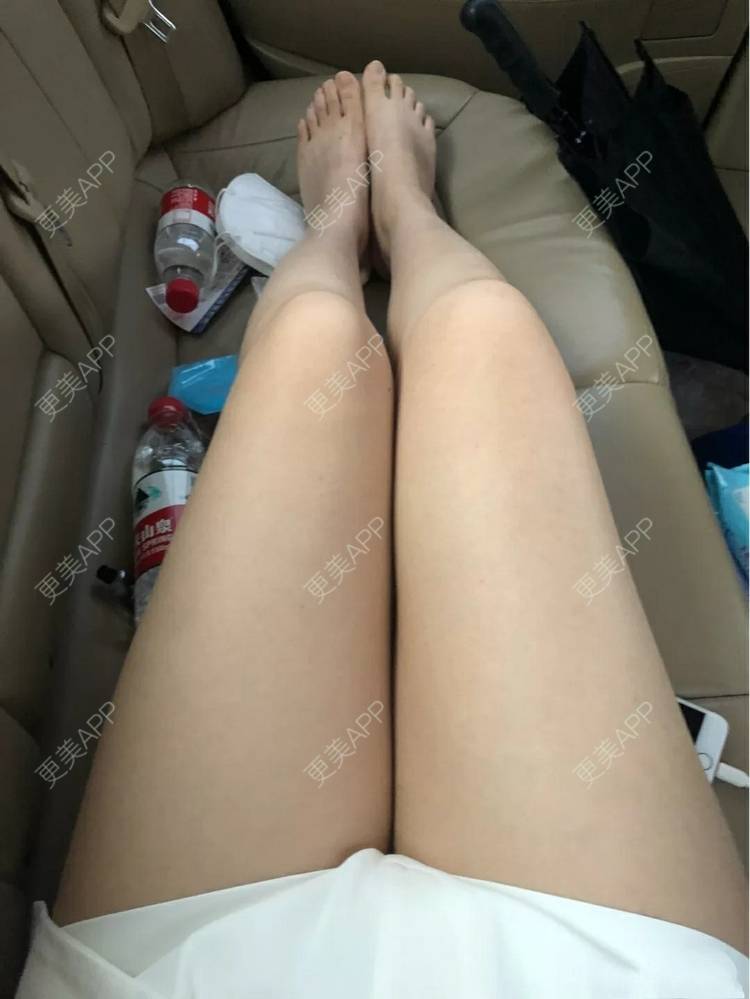 更美 - 小圈圈2的吸脂瘦大腿经验 | 南昌 | 吸脂瘦大腿