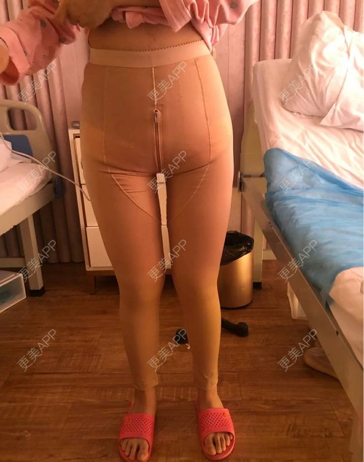 更美 - 小圈圈2的吸脂瘦大腿经验 | 南昌 | 吸脂瘦大腿