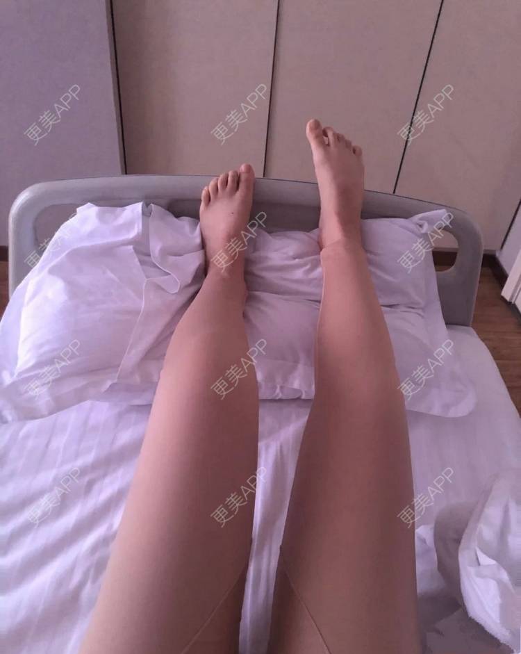 更美 - 小圈圈2的吸脂瘦大腿经验 | 南昌 | 吸脂瘦大腿