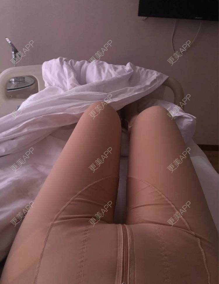 更美 - 小圈圈2的吸脂瘦大腿经验 | 南昌 | 吸脂瘦大腿