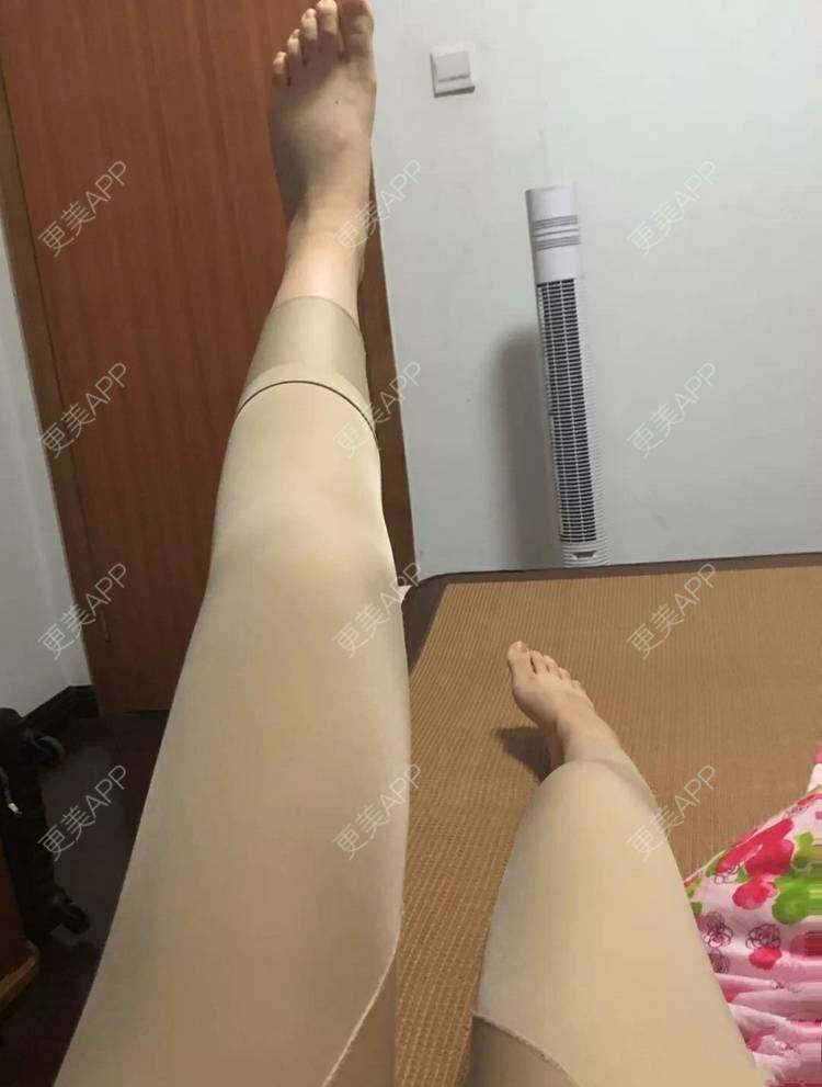 更美 - 小圈圈2的吸脂瘦大腿经验 | 南昌 | 吸脂瘦大腿