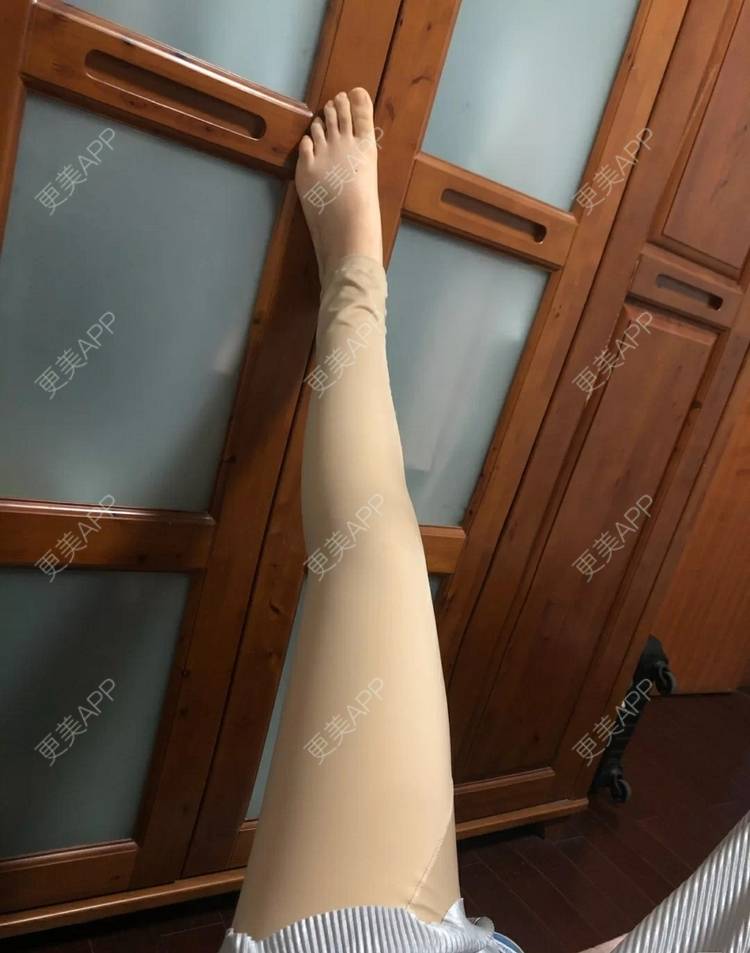 更美 - 小圈圈2的吸脂瘦大腿经验 | 南昌 | 吸脂瘦大腿