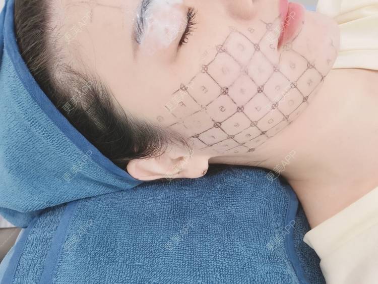 更美 - 更美用户MCO9lDrLlZ的热玛吉经验 | 重庆 | 热玛吉