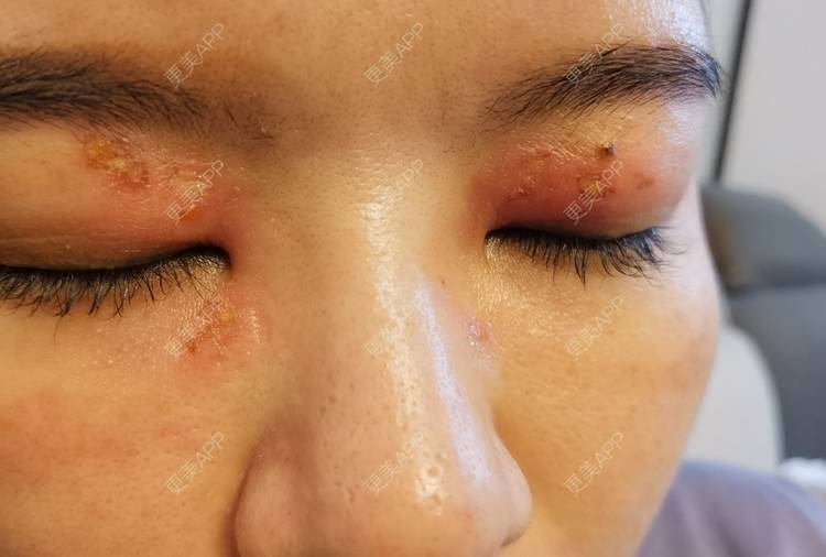 更美 - 更美用户MCO9lDrLlZ的热玛吉经验 | 重庆 | 热玛吉