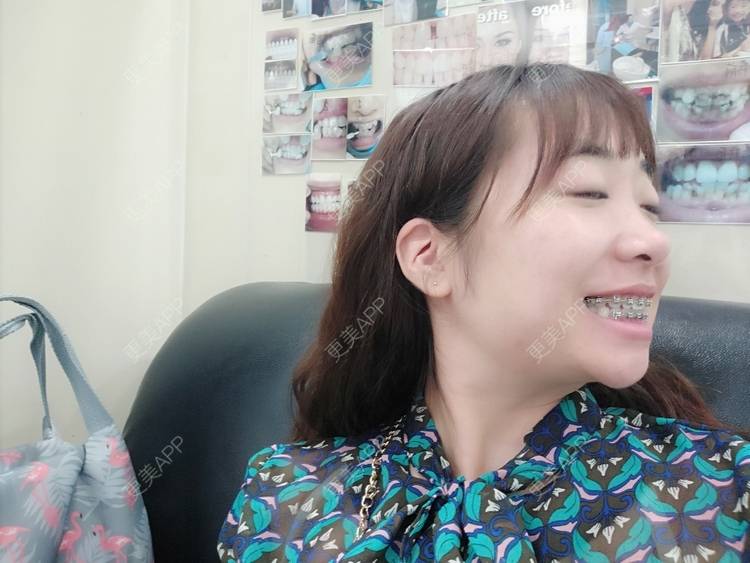 更美 - 橙子Jiang的牙齿矫正经验 | 牙齿矫正 | 成都