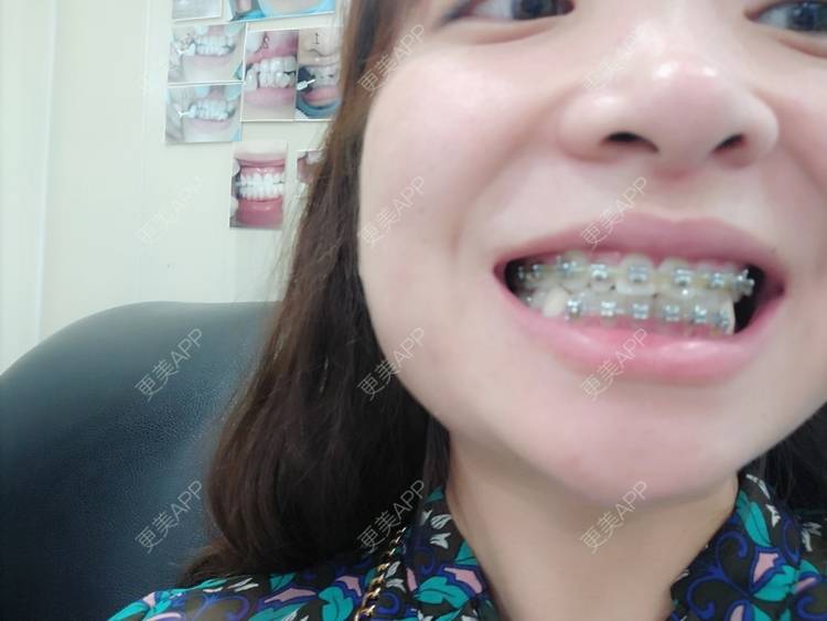 更美 - 橙子Jiang的牙齿矫正经验 | 牙齿矫正 | 成都