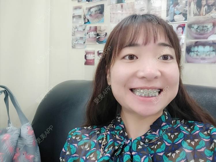 更美 - 橙子Jiang的牙齿矫正经验 | 牙齿矫正 | 成都