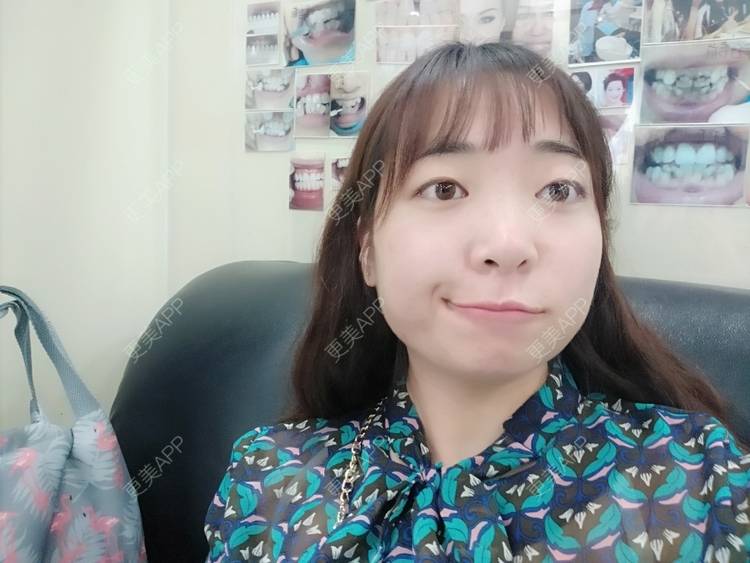 更美 - 橙子Jiang的牙齿矫正经验 | 牙齿矫正 | 成都