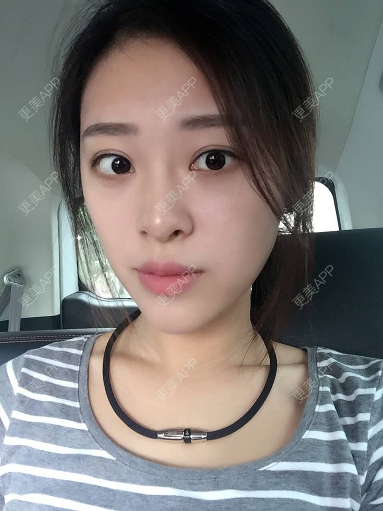 更美 - 更美用户Q7MwbEHUmr的胶原蛋白丰太阳穴经验 | 玻尿酸太阳穴 | 胶原蛋白丰太阳穴 | 深圳
