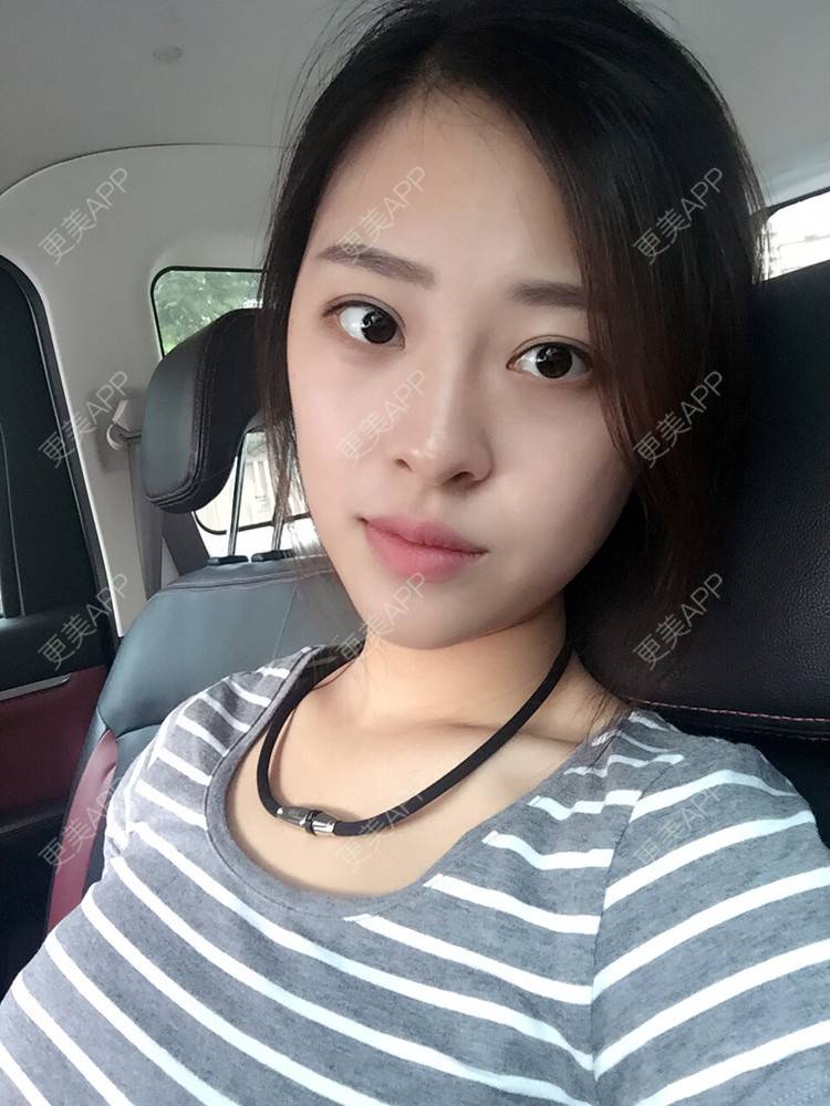 更美 - 更美用户Q7MwbEHUmr的胶原蛋白丰太阳穴经验 | 玻尿酸太阳穴 | 胶原蛋白丰太阳穴 | 深圳