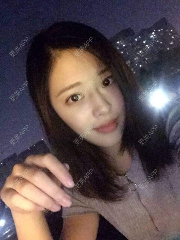 更美 - 更美用户Q7MwbEHUmr的胶原蛋白丰太阳穴经验 | 玻尿酸太阳穴 | 胶原蛋白丰太阳穴 | 深圳
