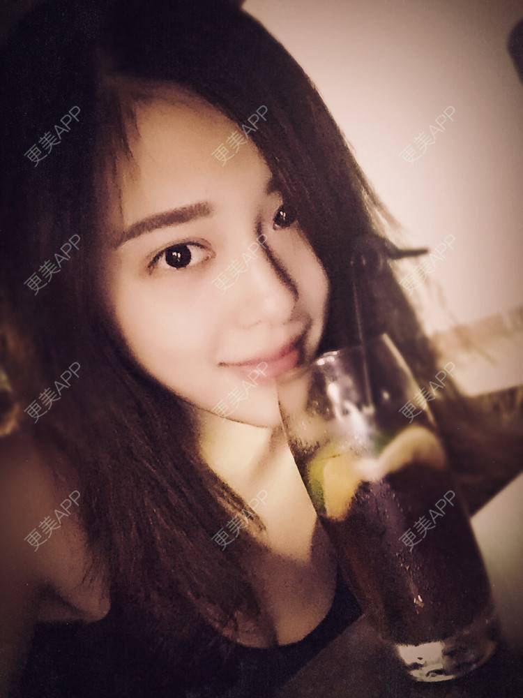 更美 - 更美用户Q7MwbEHUmr的胶原蛋白丰太阳穴经验 | 玻尿酸太阳穴 | 胶原蛋白丰太阳穴 | 深圳