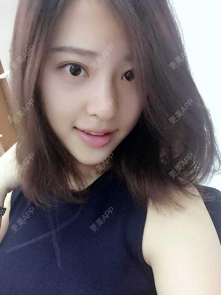 更美 - 更美用户Q7MwbEHUmr的胶原蛋白丰太阳穴经验 | 玻尿酸太阳穴 | 胶原蛋白丰太阳穴 | 深圳