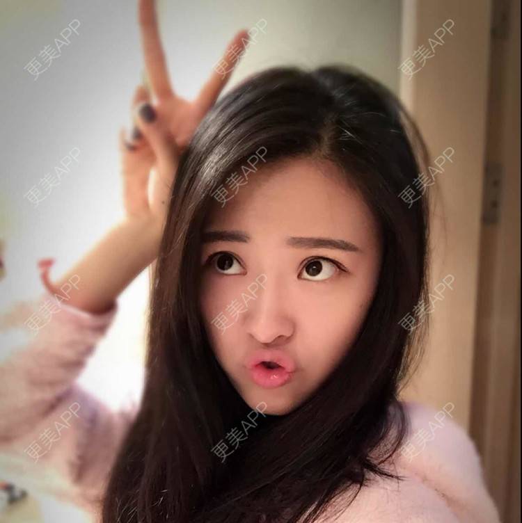 更美 - 更美用户Q7MwbEHUmr的胶原蛋白丰太阳穴经验 | 玻尿酸太阳穴 | 胶原蛋白丰太阳穴 | 深圳
