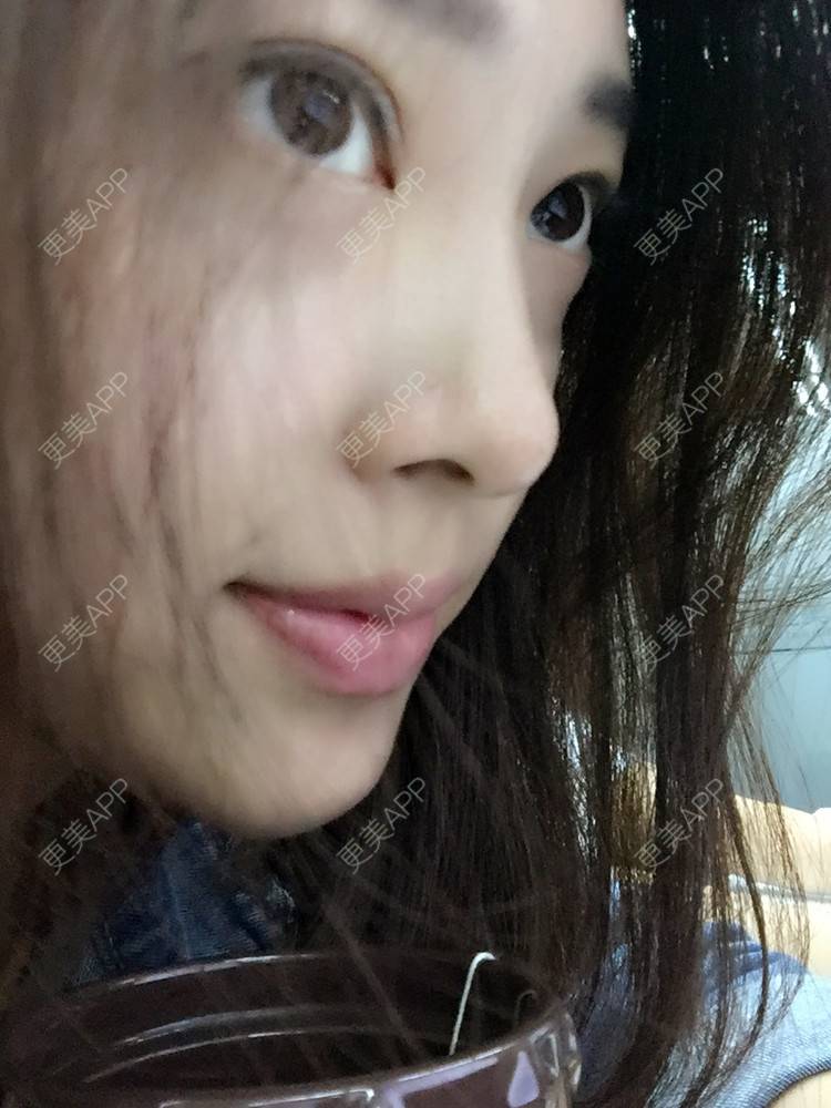 更美 - 更美用户Q7MwbEHUmr的胶原蛋白丰太阳穴经验 | 玻尿酸太阳穴 | 胶原蛋白丰太阳穴 | 深圳