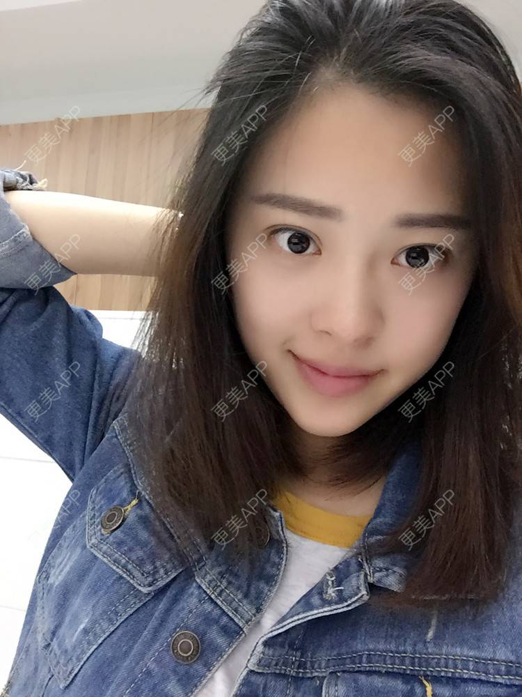 更美 - 更美用户Q7MwbEHUmr的胶原蛋白丰太阳穴经验 | 玻尿酸太阳穴 | 胶原蛋白丰太阳穴 | 深圳