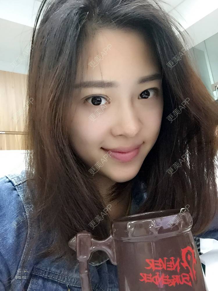 更美 - 更美用户Q7MwbEHUmr的胶原蛋白丰太阳穴经验 | 玻尿酸太阳穴 | 胶原蛋白丰太阳穴 | 深圳