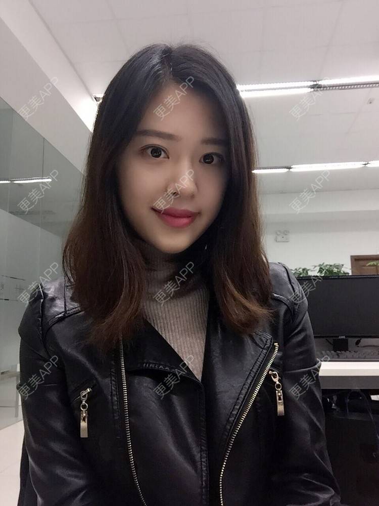 更美 - 更美用户Q7MwbEHUmr的胶原蛋白丰太阳穴经验 | 玻尿酸太阳穴 | 胶原蛋白丰太阳穴 | 深圳