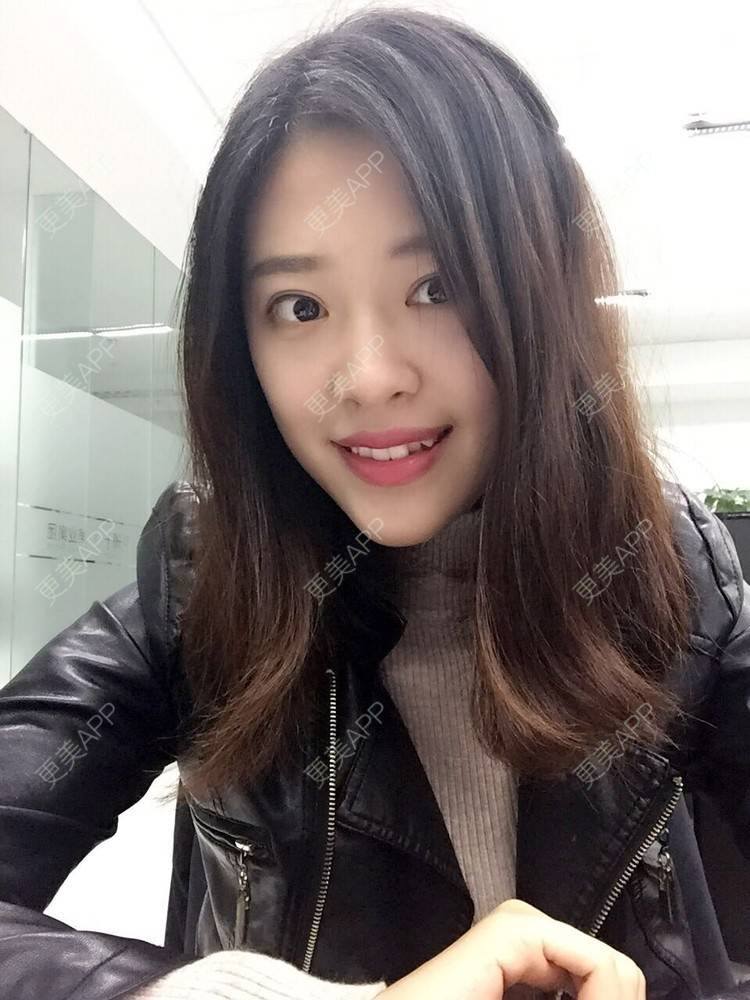 更美 - 更美用户Q7MwbEHUmr的胶原蛋白丰太阳穴经验 | 玻尿酸太阳穴 | 胶原蛋白丰太阳穴 | 深圳