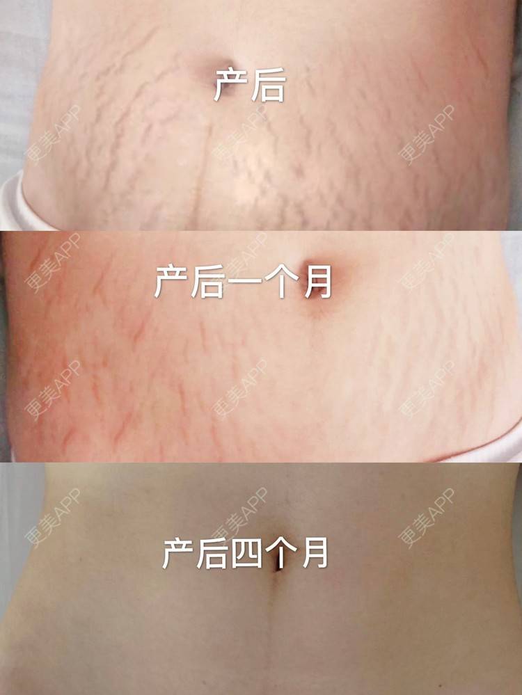 产后修复对比图_the贤寳产后修复对比图_术后167天__更美