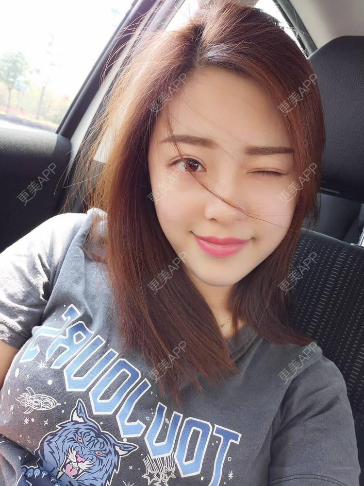 更美 - 更美用户Q7MwbEHUmr的胶原蛋白丰太阳穴经验 | 玻尿酸太阳穴 | 胶原蛋白丰太阳穴 | 深圳