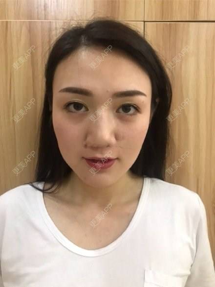 更美 - 生活就要自然一些挡的胶原蛋白丰泪沟经验 | 胶原蛋白丰泪沟 | 武汉