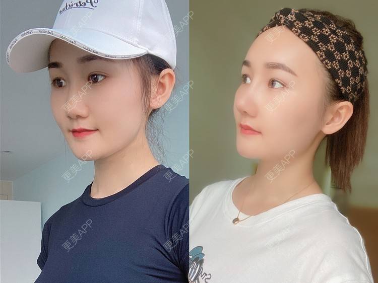 更美 - Yancy🧚‍♀️的隆鼻经验 | 隆鼻 | 鼻部多项 | 膨体隆鼻 | 肋软骨隆鼻 | 鼻翼缩小 | 深圳 | 长鼻矫正 | 视频日记