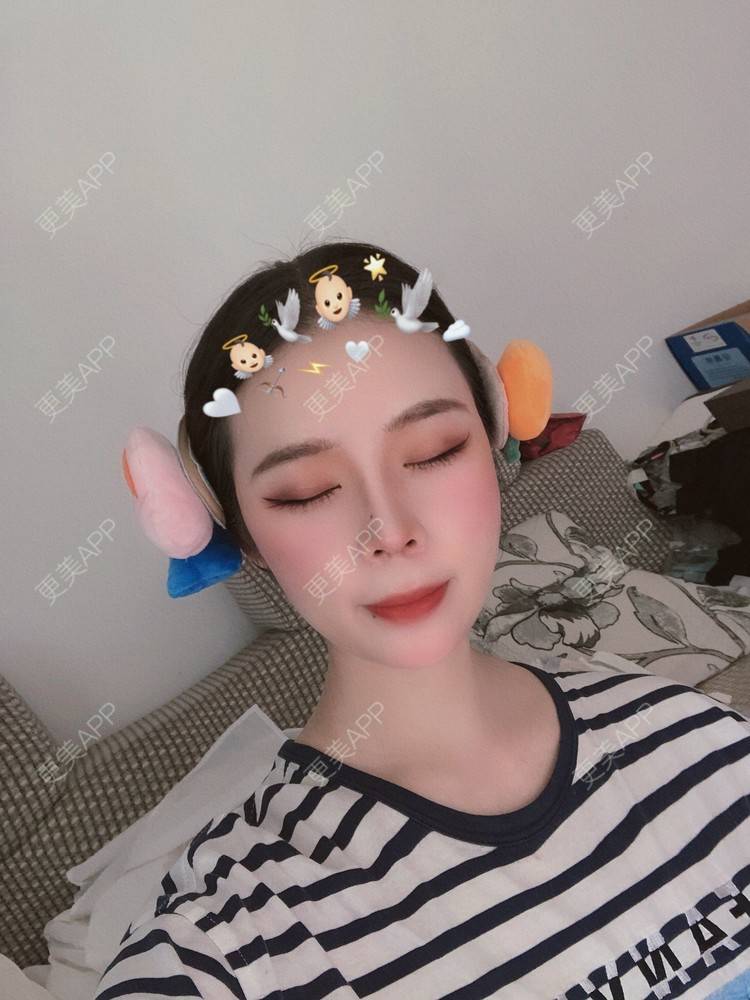 更美 - 超级超级好吃的鼻部多项经验 | 肋软骨隆鼻 | 耳软骨隆鼻 | 鼻中隔软骨隆鼻 | 自体肋软骨垫鼻基底 | 自体软骨垫鼻尖 | 鼻部多项 | 手术缩鼻头 | 鼻中隔软骨垫鼻头 | 注射缩鼻头 | 鼻小柱缩短