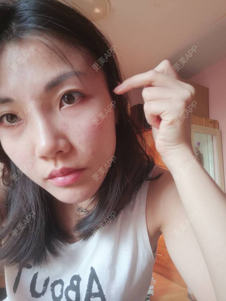 更美 - 更美用户14DudTE5rp的太阳穴经验 | 太阳穴 | 硅胶丰太阳穴 | 膨体丰太阳穴 | 胶原蛋白丰太阳穴 | 玻尿酸太阳穴 | 武汉 | 丰太阳穴