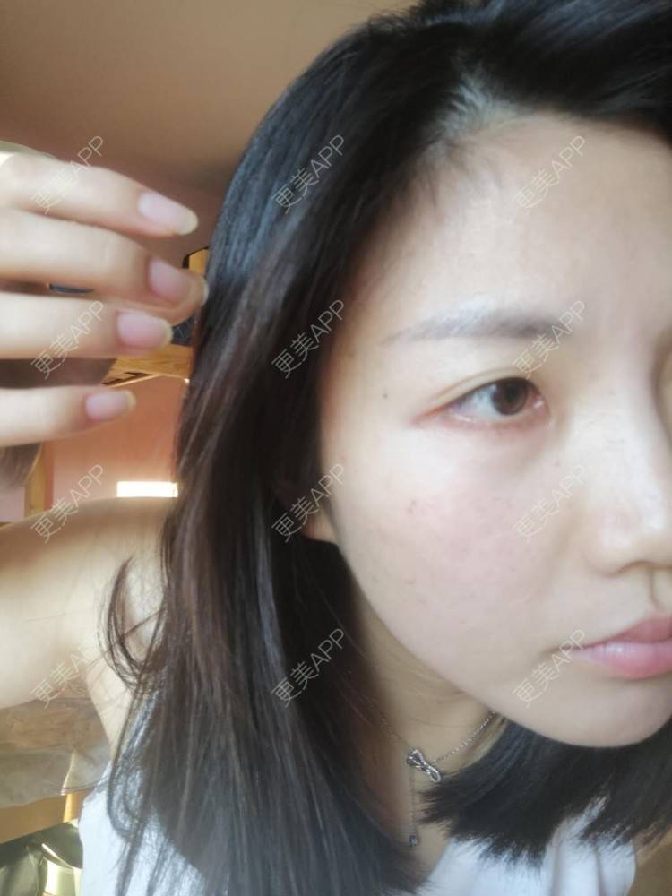 更美 - 更美用户14DudTE5rp的太阳穴经验 | 太阳穴 | 硅胶丰太阳穴 | 膨体丰太阳穴 | 胶原蛋白丰太阳穴 | 玻尿酸太阳穴 | 武汉 | 丰太阳穴