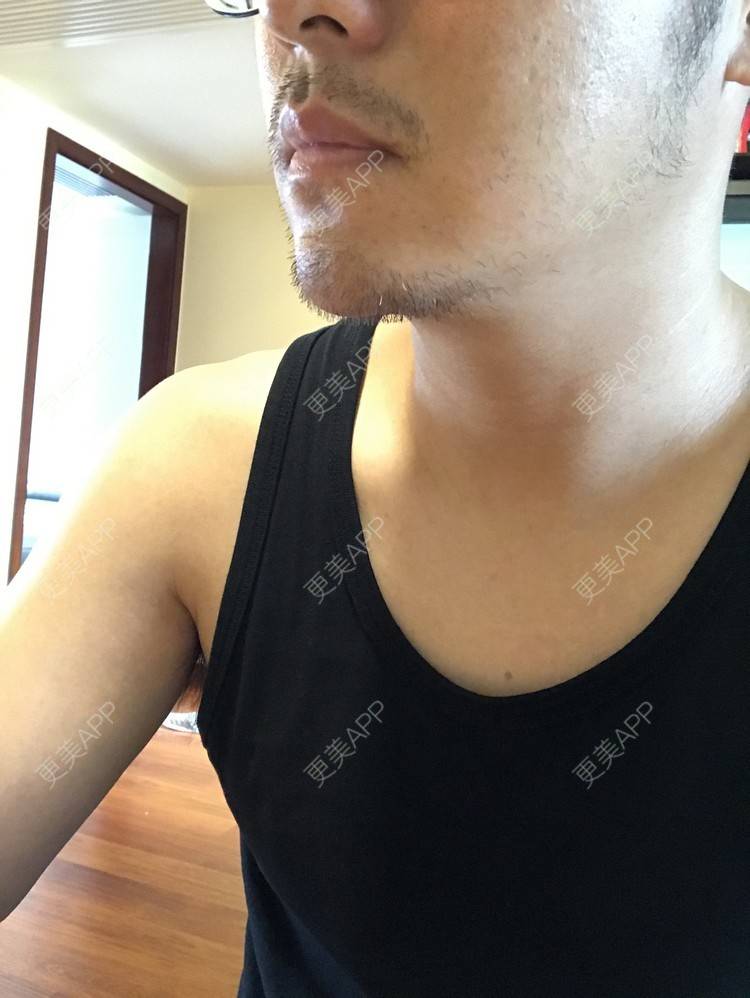 更美 - 倔强的老草的除皱瘦脸经验 | 除皱瘦脸 | 上海