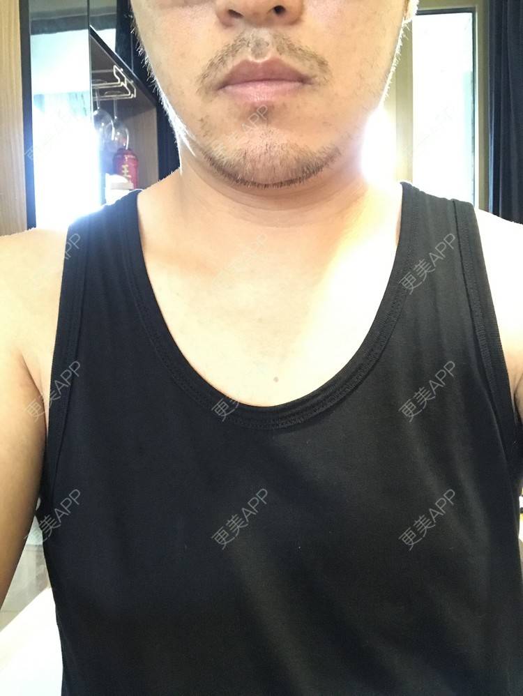 更美 - 倔强的老草的除皱瘦脸经验 | 除皱瘦脸 | 上海