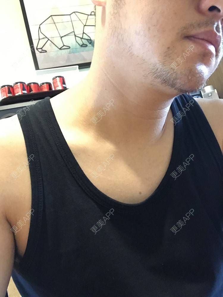 更美 - 倔强的老草的除皱瘦脸经验 | 除皱瘦脸 | 上海