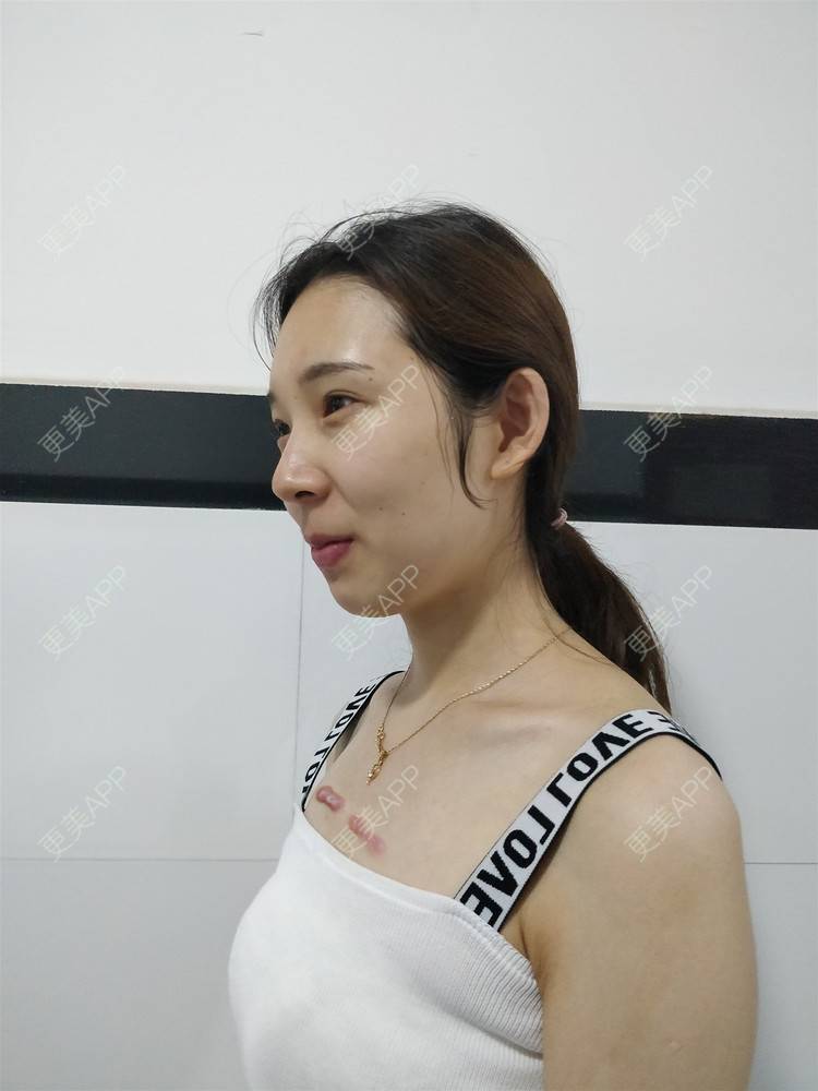 更美 - 十雾亿的综合淡疤经验 | 综合淡疤 | 北京