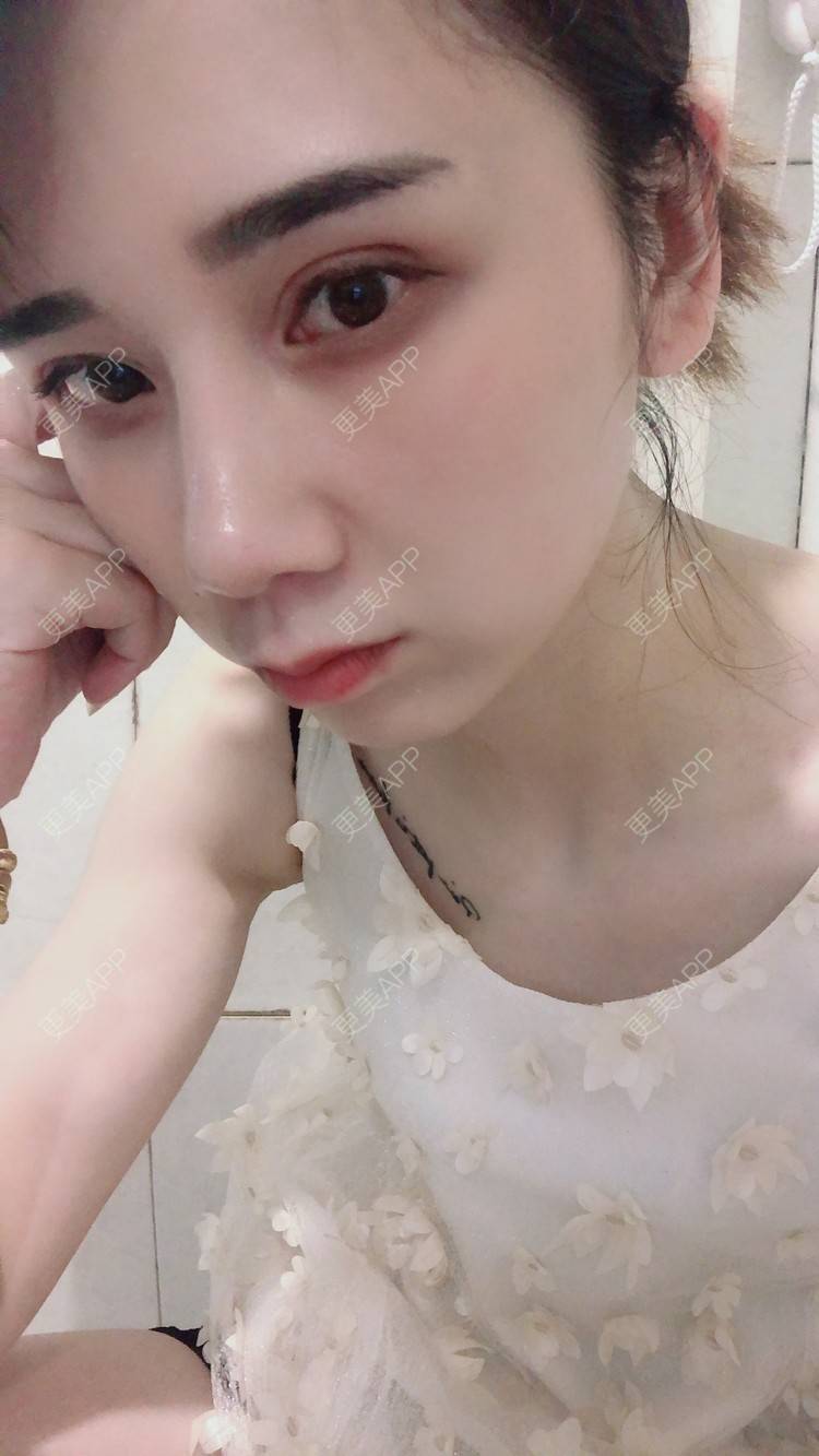 更美 - 半个柚子不加C的鼻部多项经验 | 自体肋软骨垫鼻基底 | 假体垫鼻基底 | 自体脂肪垫鼻基底 | 玻尿酸鼻基底 | 鼻中隔软骨垫鼻头 | 鼻基底