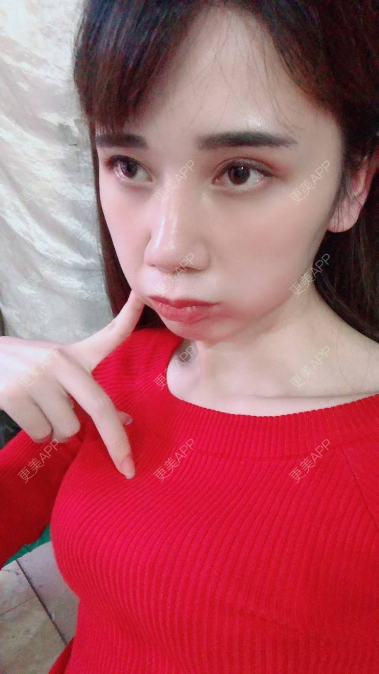 更美 - 半个柚子不加C的鼻部多项经验 | 自体肋软骨垫鼻基底 | 假体垫鼻基底 | 自体脂肪垫鼻基底 | 玻尿酸鼻基底 | 鼻中隔软骨垫鼻头 | 鼻基底