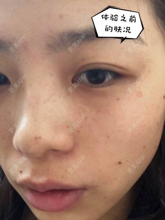 更美 - 更美用户DrgBVKI7yN的皮秒激光经验 | 皮秒激光 | 上海
