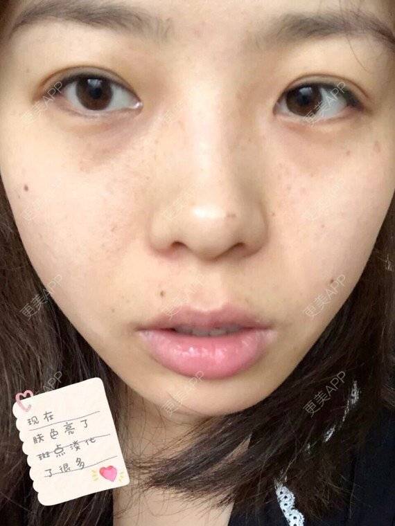 更美 - 更美用户DrgBVKI7yN的皮秒激光经验 | 皮秒激光 | 上海